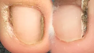 The worst toenail on earth!Thorn inside the toe