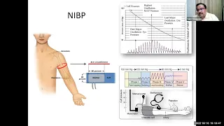 Hemodynamic monitoring What, When & How