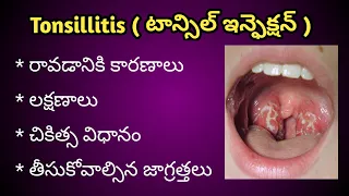 Tonsil Infection|టాన్సిల్ ఇన్ఫెక్షన్|Tonsillitis|Causes , Symptoms and Treatment in Telugu.