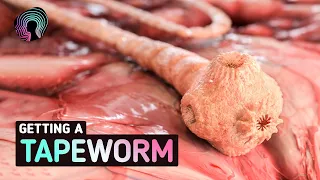 What Happens When You Get Tapeworms? (Warning: distressing footage)