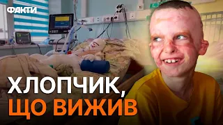 З такими опіками НЕ ЖИВУТЬ, але РОМЧИК ЗМІГ! Про обстріл, боротьбу та ВЕЛИКУ МРІЮ в пам'ять про МАМУ