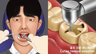 ASMR 환자분 조금만 참으세요~ 충치치료 애니메이션 part2 | 치과 충치제거  | Satisfying caries removal animation | Dental care