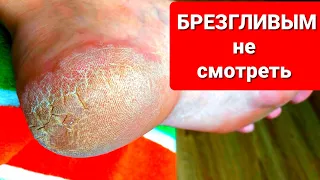 Как быстро удалить мозоли и натоптыши 👣 Очень простой способ Глубокие  трещины на пятках