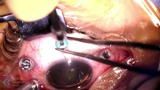 DESPRENDIMIENTO DE RETINA Y DESPRENDIMIENTO DE VÍTREO POSTERIOR.