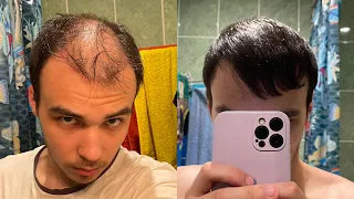 Результат пересадки волос 12 месяцев, 5000 графтов