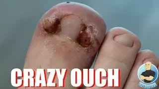 WHAT HAPPENS WHEN INGROWN TOENAILS AREN'T TREATED?!