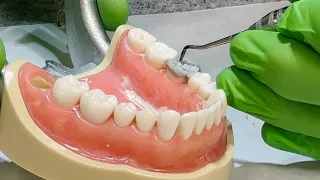 Occlusal Wax Up Demonstration Tooth #19 - Dr. Chris Vernon