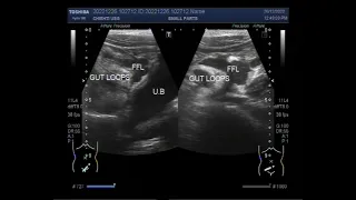 Dilated Gut loops with Intestinal obstruction and perforation in a child of about 6 years.