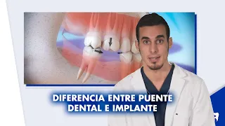 ¿Cuál es la diferencia entre un IMPLANTE dental y un PUENTE dental? | #Shorts