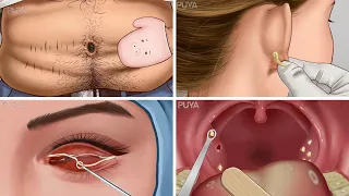 ASMR Dirt and stone removal in deep belly button| Remove Huge Navel Stone Animation