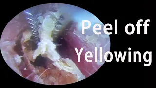 Peel off earwax carefully! Severe yellowing【Ears Craftsman】