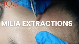 MILIA EXTRACTIONS PART TWO  | MILIA MEDLEY