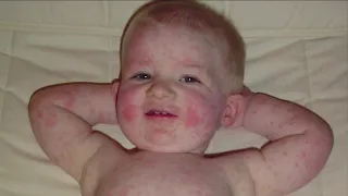 Doctor's offices seeing cases of fifth disease