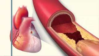 NSAIDs and Heart Disease - Mayo Clinic