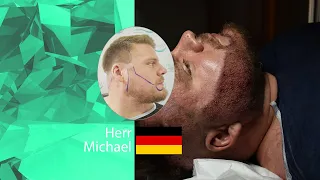 Herr Michael aus Deutschland 🇩🇪 -Barttransplantation in der Turkei