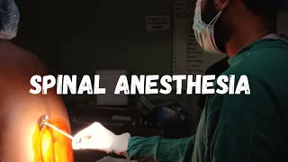 How to give spinal anesthesia ? LEARN IN 1 MINUTE