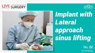 Lateral sinus lift with simultaneous implant placement [Live surgery - Dr. Jeon Inseong]