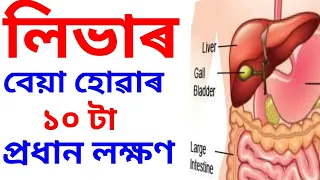 লিভাৰ বেয়া হোৱা ১০ টা লক্ষণ || 10 Early symptoms of liver damage: Dr Haris Well future