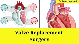 Heart valve replacement surgery: What you need to know