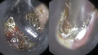 84 - Complex Referred Ear Wax Removal with WAXscope®️