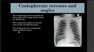 Chest Imaging Made Easy Course : Lecture 03 Normal chest X-ray anatomy part 2