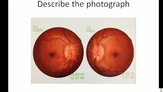 OPHTHALMOLOGY : DISCUSSION OVER OPTIC DISC OEDEMA