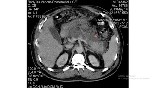 Valoración Tomografíca de Pancreatitis Aguda- Criterios de Baltazar - Dr Jorge Sibina