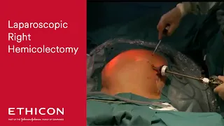 Laparoscopic Right Hemicolectomy HARMONIC ACE®+ Shears