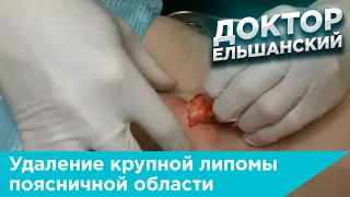 Удаление крупной липомы поясничной области при липоматозе