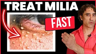 MILIA // How To Treat and Prevent Them