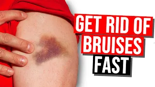 How to Get Rid of Bruises in 2024