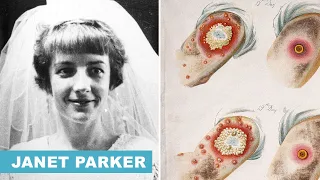 La drammatica storia di Janet Parker: l’ultimo essere umano a morire di Vaiolo