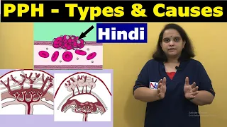 Postpartum hemorrhage in Hindi | Causes and Types of PPH | Nursing Lecture