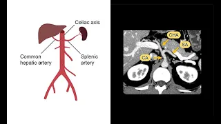 Evaluating the abdominal arteries (aorta) with the help of CT