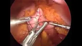 NJ Gastric Bypass Surgery: LIVE Procedure by Dr. Alexander Abkin