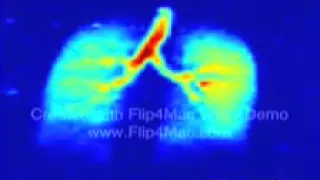 MRI Xenon example