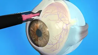 Хирургия глаукомы  (Glaucoma Surgery) - 1