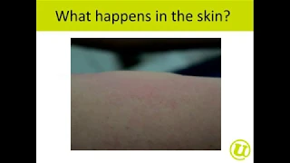 2019 10 01 16 50 Webinar Urticaria english