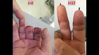 Replantation de deux doigts