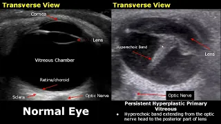 Eye Ultrasound Normal Vs Abnormal Images | Cataract/Retinal Detachment/Globe Rupture/Choroid USG