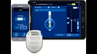 Deep brain stimulation - Percept Neurostimulator