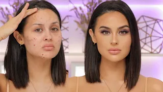 Flawless Skin Transformation With Makeup For Acne Breakouts