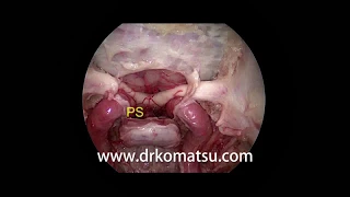 #A15 Suprasellar area ; Anatomy for Endoscopic Endonasal Skull Base Surgery