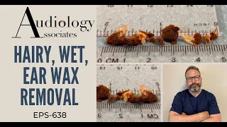 HAIRY, WET EAR WAX REMOVAL - EP638