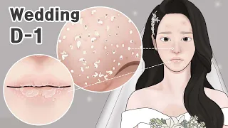 ASMR Wedding D-1 !! Pimple Popping, Blackhead Removal, Lip Scrub TOTAL SKINCARE ANIMATION  LULUPANG