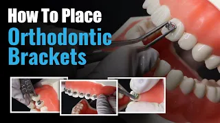 How to place Orthodontic Brackets | Waldent Metal Bracket Kit MBT 022 Slot