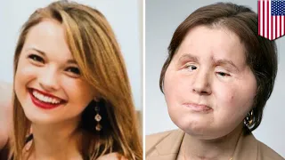 Woman youngest face transplant recipient in U.S. at 21 - TomoNews