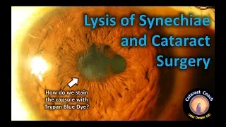 Lysis of Synechiae and Cataract Surgery - Tips & Tricks
