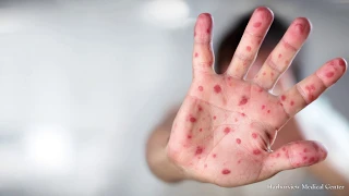 Washington state faces measles outbreak