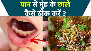 Mouth Ulcer में पान खाने से क्या होता है | पान से मुंह के छाले कैसे ठीक करें | Boldsky